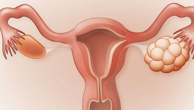 Polycystic Ovarian Syndrome: PCOS