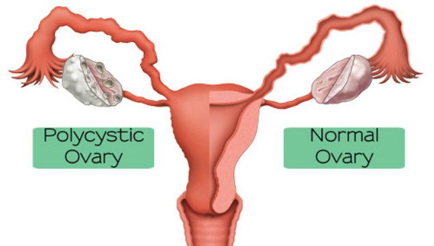 How PCOS Affects Fertility