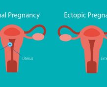 Difficulty Getting Pregnant after Ectopic Pregnancy