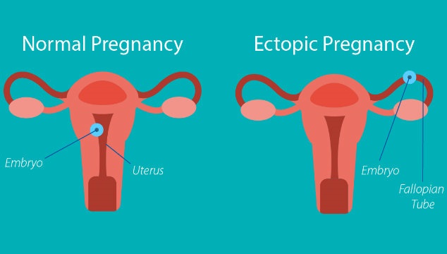 Difficulty Getting Pregnant after Ectopic Pregnancy