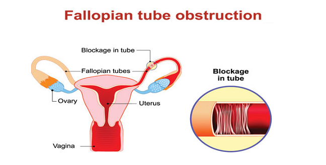 blocked fallopian tubes
