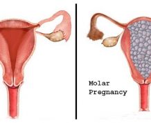 Molar Pregnancy Symptoms, Risks and Treatment