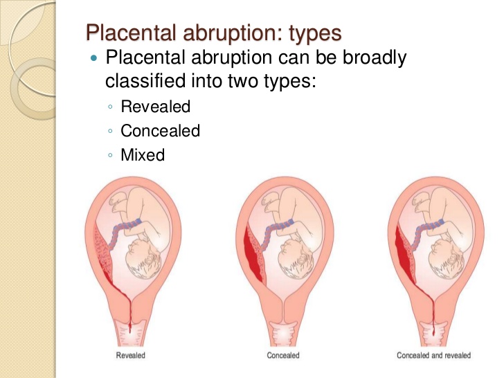 abruption type